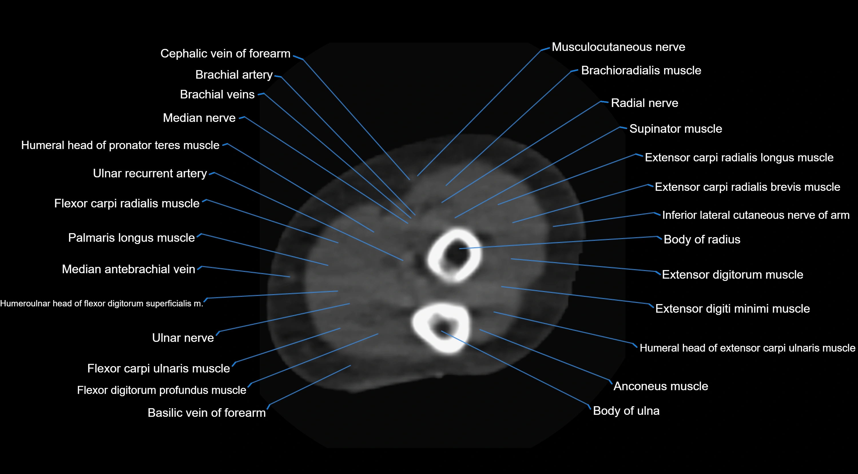 CT elbow axial  cross sectional anatomy labelled  radiology image -00045.webp